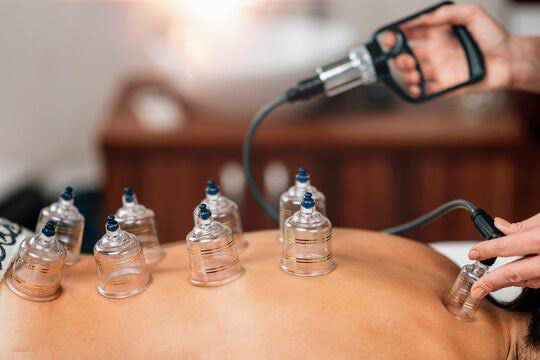 Cupping Therapy